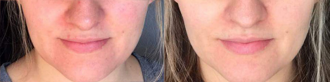 miglioramento-rossore-del-viso-serum-lab