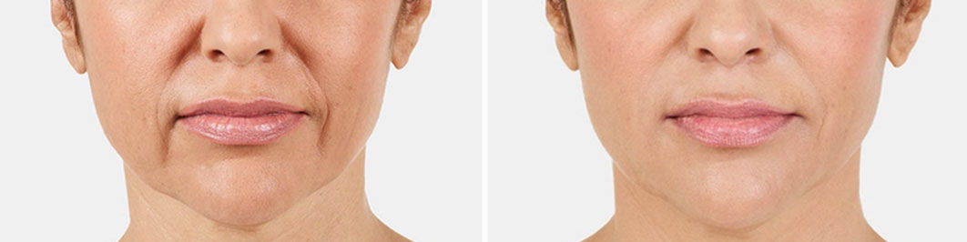 miglioramento-rughe-naso-labiale-della-marionatta--del-viso-serum-lab